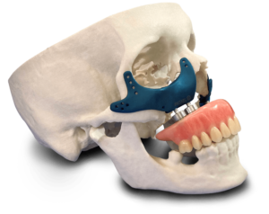 Biomodelo de crânio com próteses de maxila