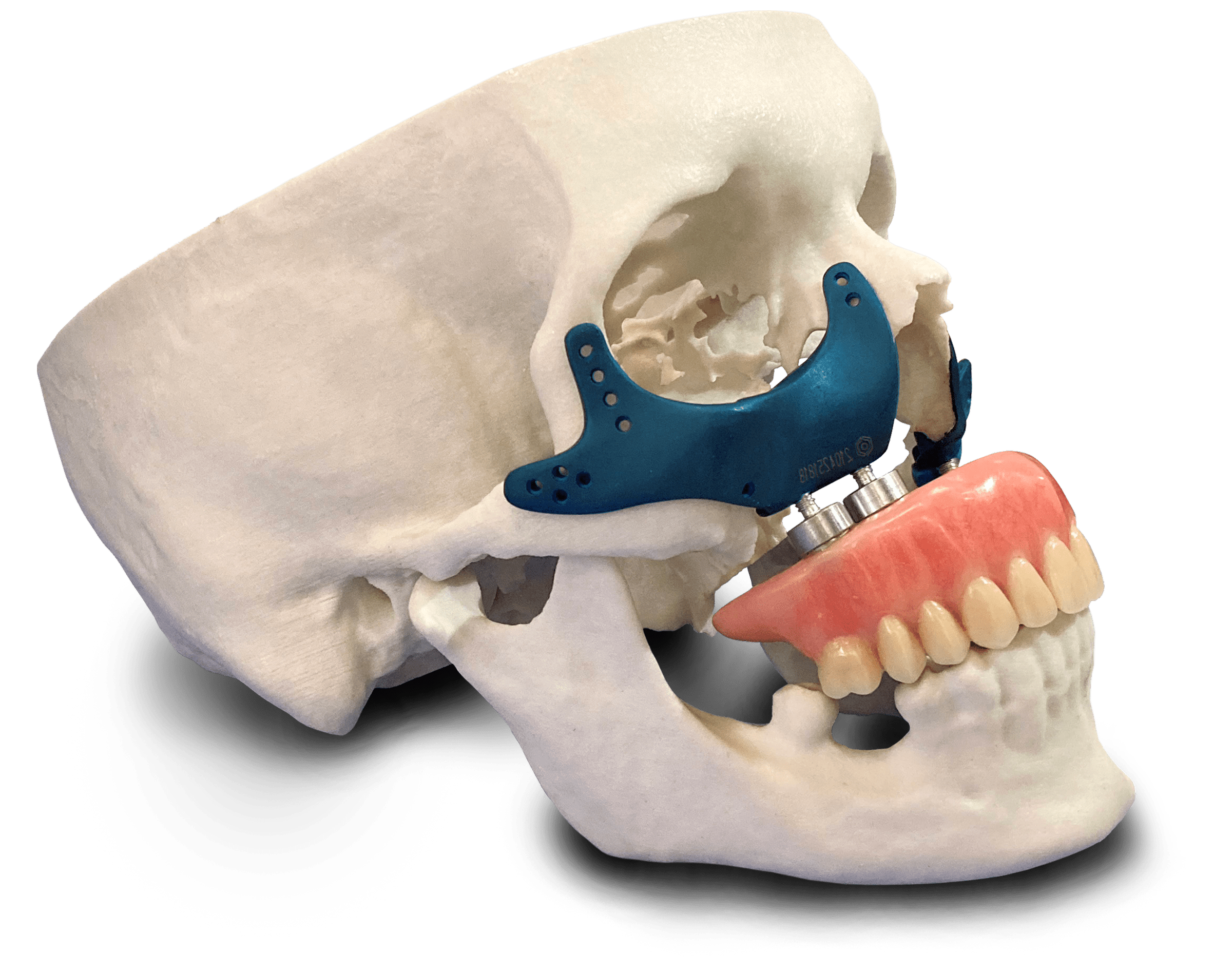 Biomodelo de crânio com próteses de maxila